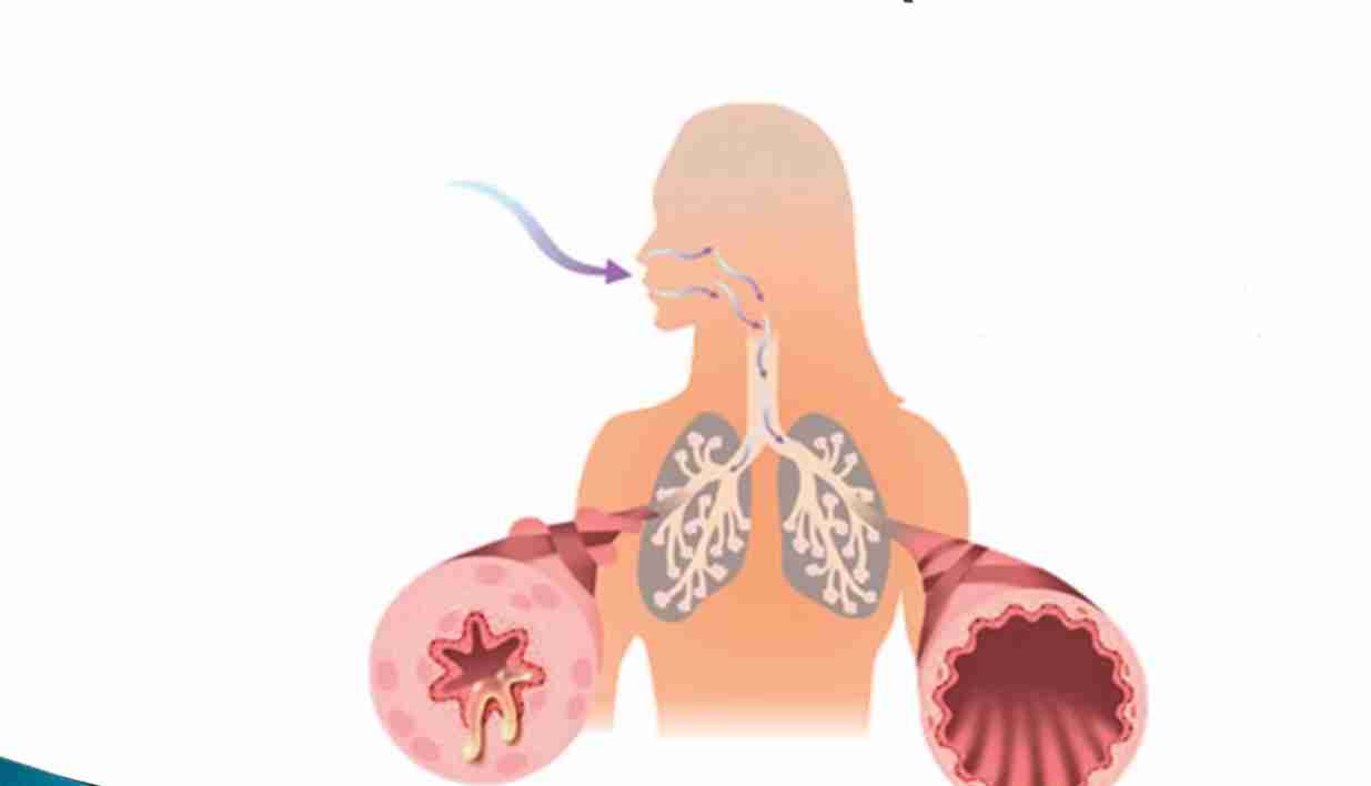 Дышать свободно: как не допустить дебюта бронхиальной астмы?