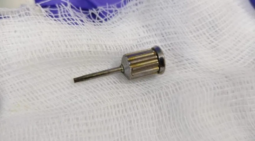 Медики ЦГБ №20 Екатеринбурга успешно извлекли стоматологическую отвёртку из кишечника женщины.