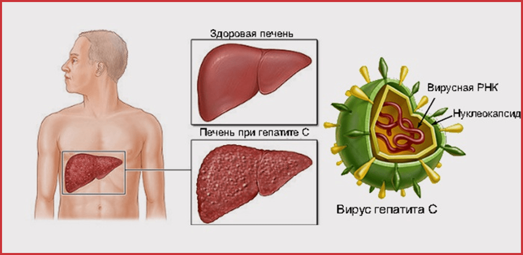 Все о ГЕПАТИТЕ С - это должен знать каждый